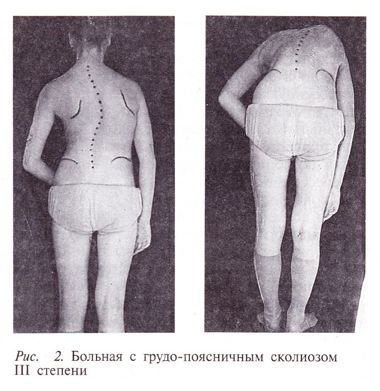 Скалиоз упражнения при скалиозе